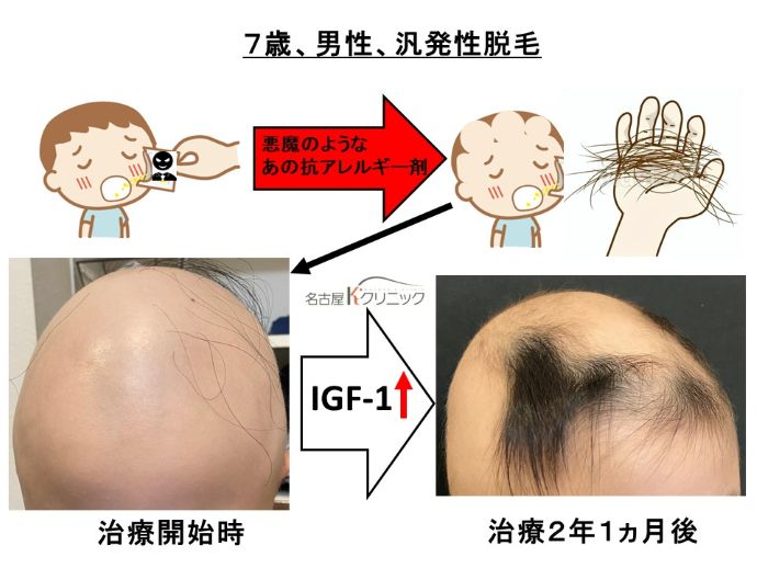 円形脱毛症　病院